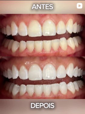 Antes e depois de tratamento estético dental